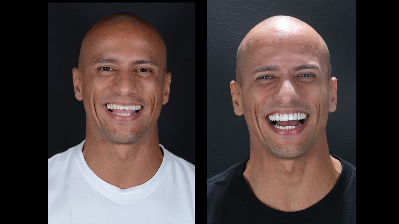 Antes e depois de tratamento odontológico na Clínica Lotus