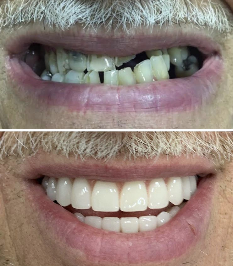 Antes e depois de reabilitação oral de paciente da Clínica Lotus