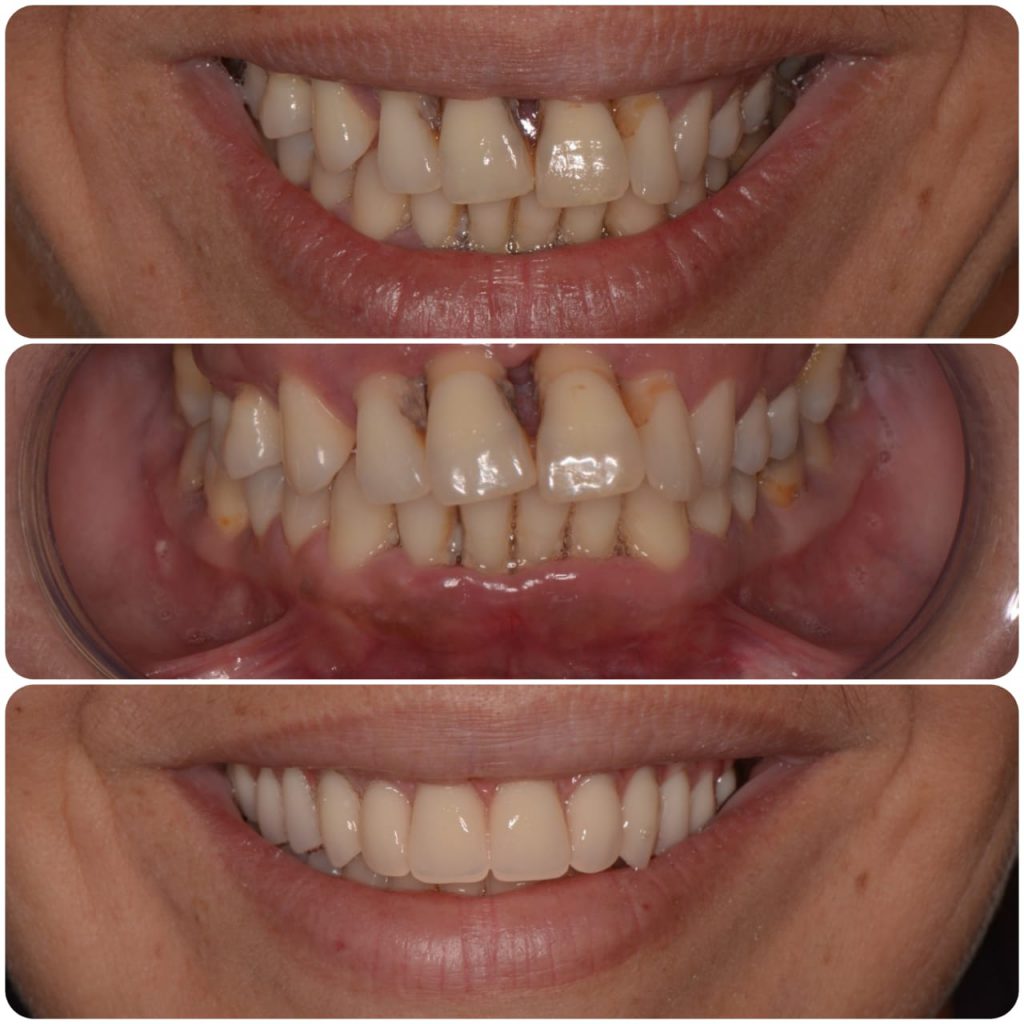 Antes e depois de transformação de sorriso na Clínica Lotus